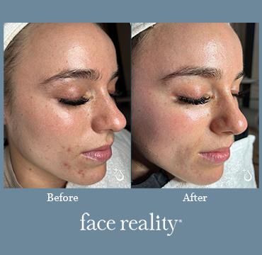 Face Reality - Acne Solutions